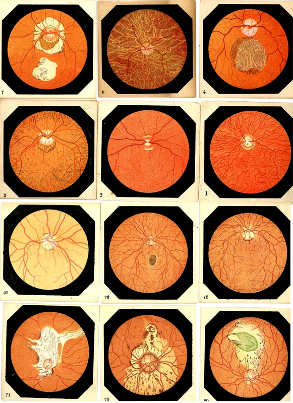 Set of Retinal Pathology Teaching Cards - click to enlarge.